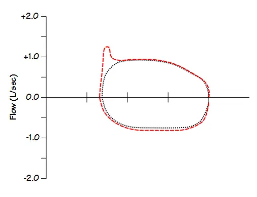 EFLt > 50% of tidal volume