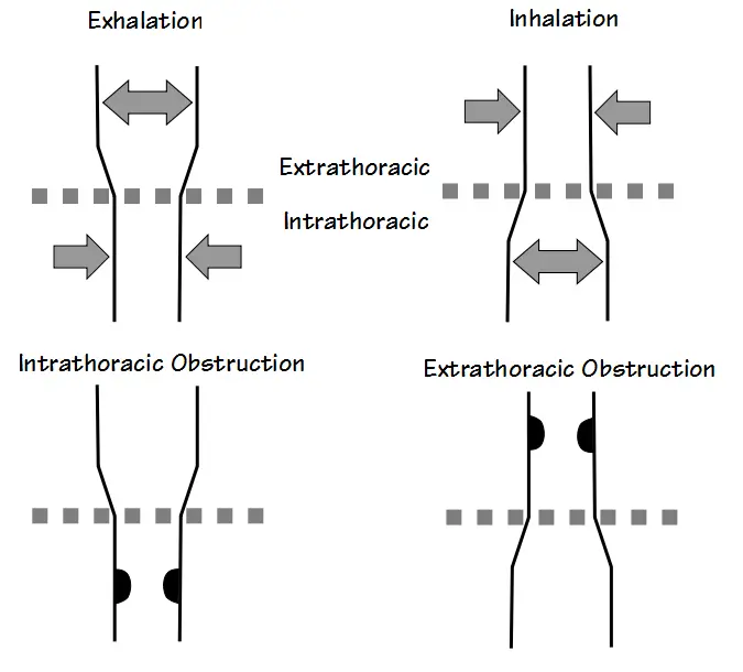 Extrathoracic Intrathoracic Obstructions