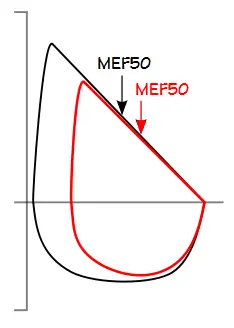 FVL_Decrease_MEF50