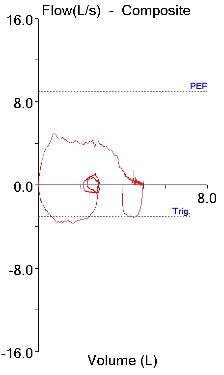 Tracheomalacia_loop