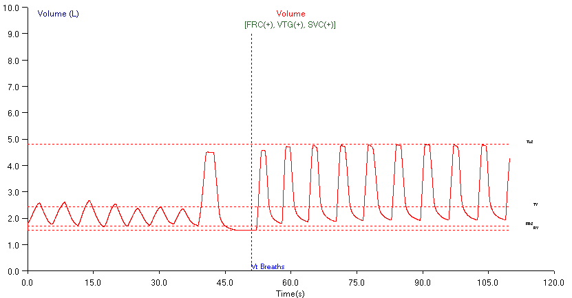 n2 washout overestimating SVC gain